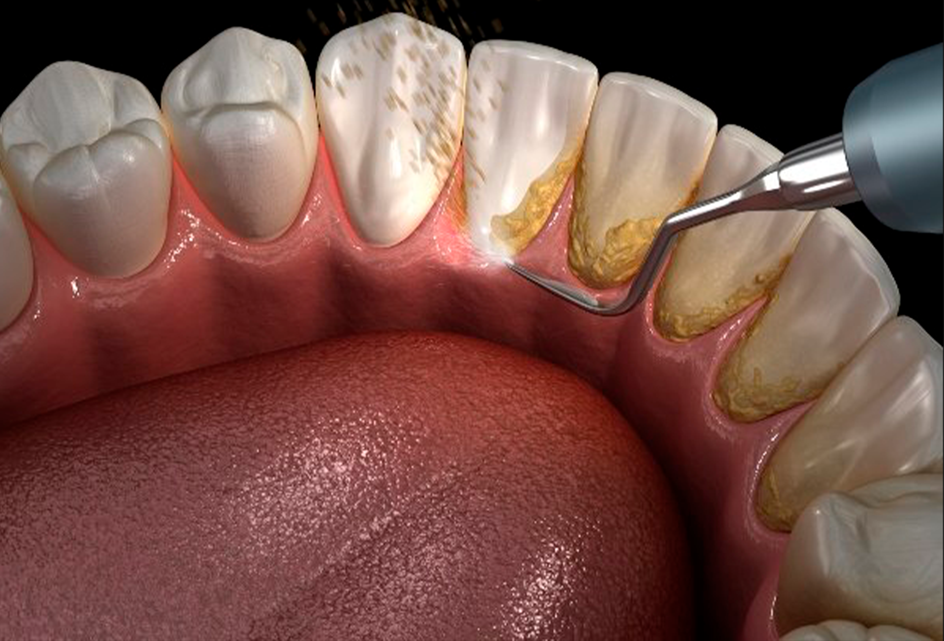 Prevención de sarro