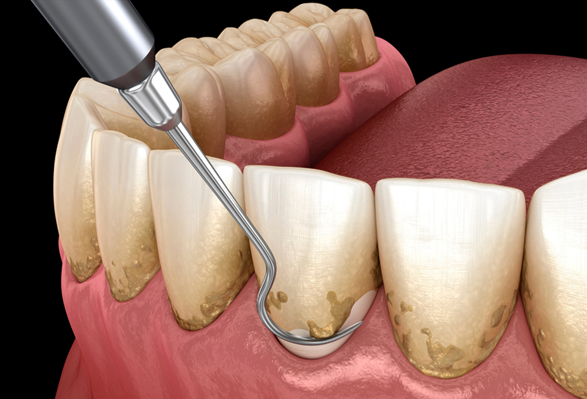 Periodoncia