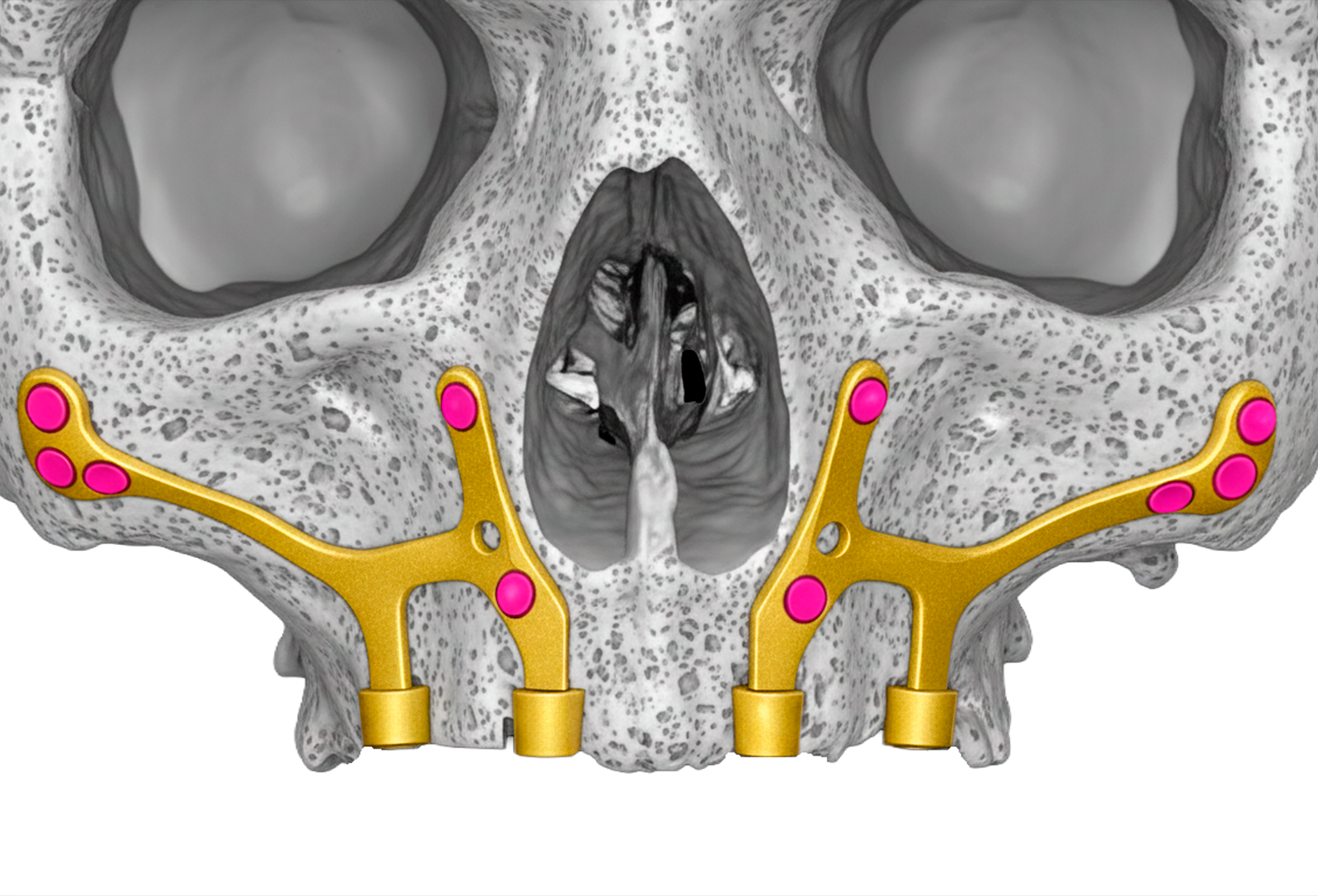 Prótesis subperióstica personalizada (PSP)