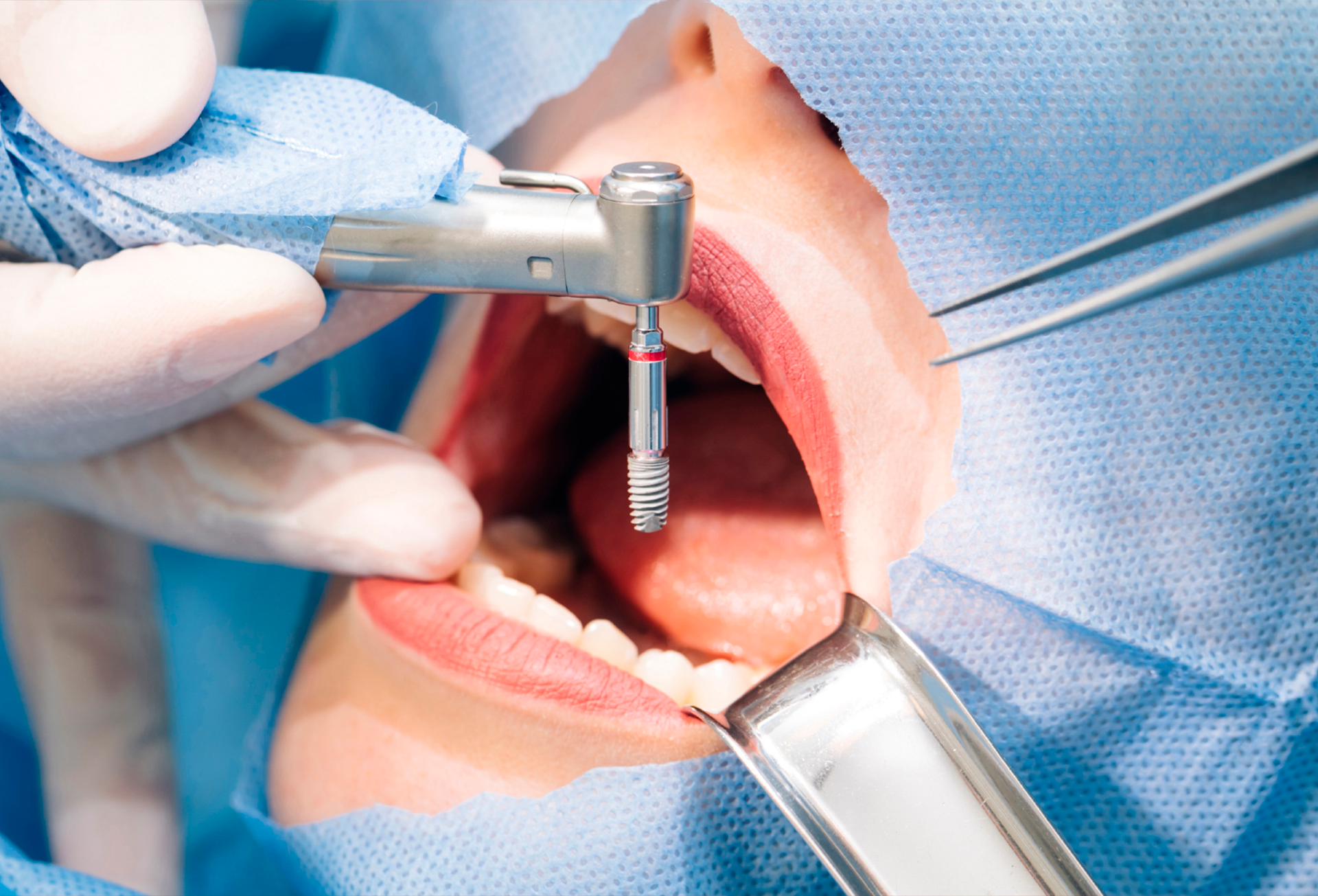 Colocación de implante