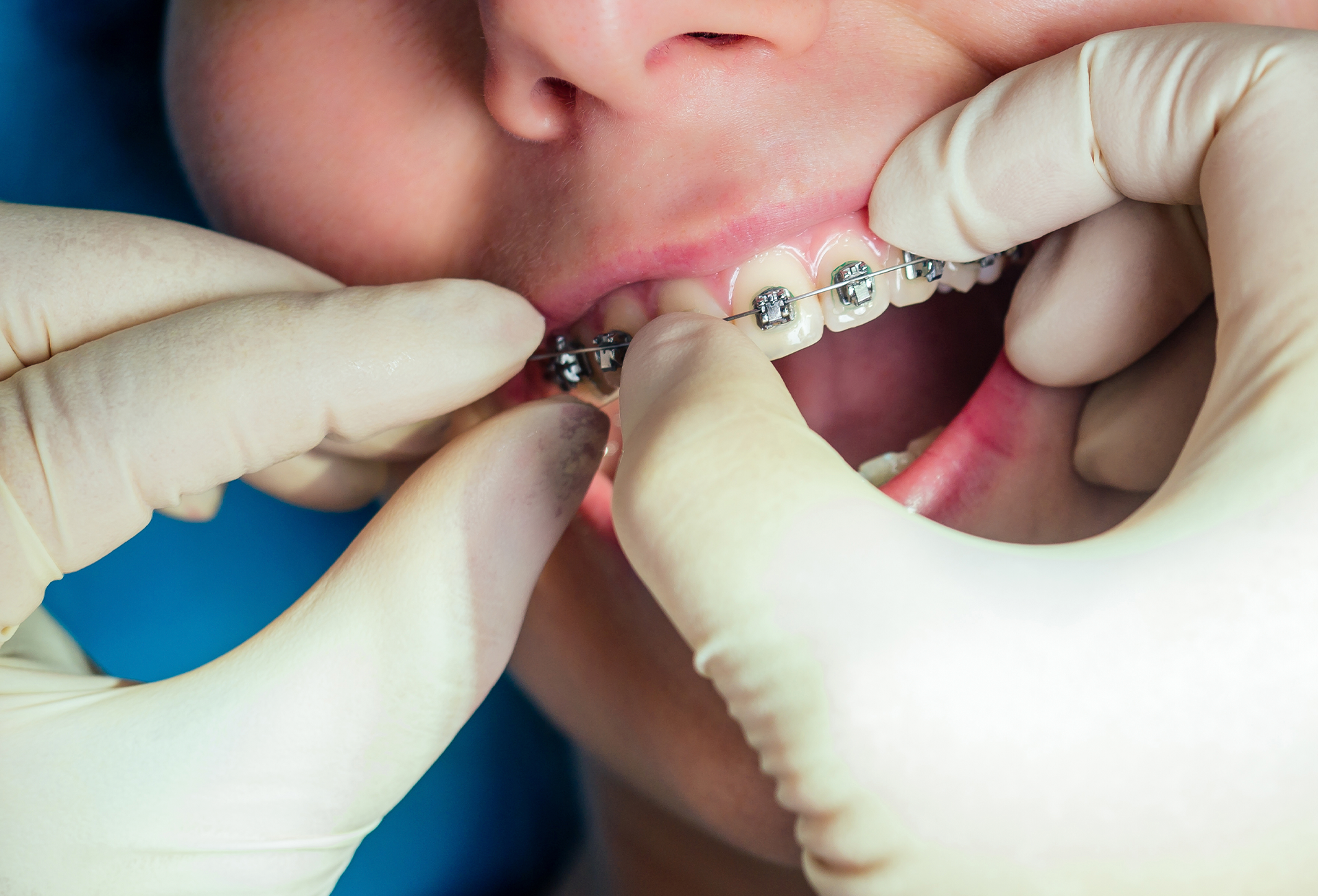 Colocación de ortodoncia (Brakets)